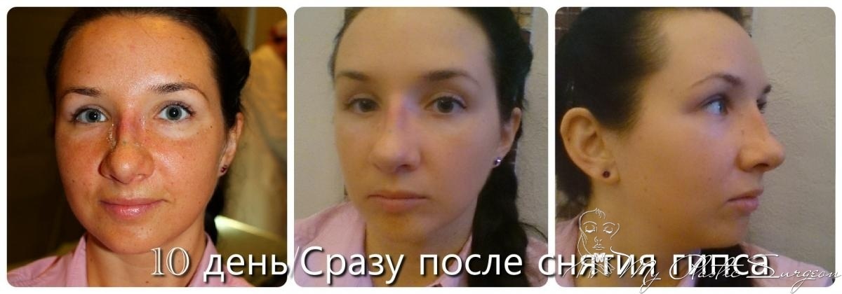 Что после снятия гипса ринопластика Что после снятия гипса ринопластика