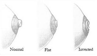 Размеры ареол у женской груди и их виды