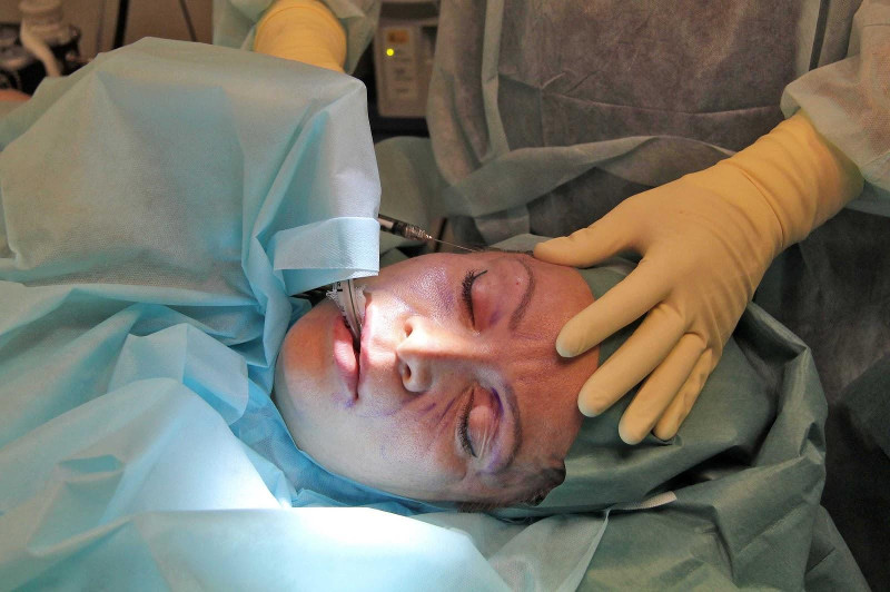 Фоторепортаж операции липофилинга лица, выполненной Жолтиковым Виталием Владимировичем