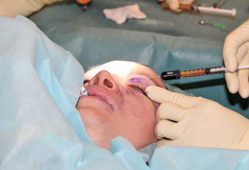 Фоторепортаж операции липофилинга лица, выполненной Жолтиковым Виталием Владимировичем