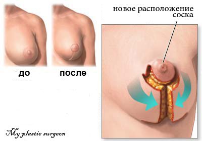 Маммопластика или Увеличение груди