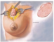 Фиброаденома груди
