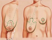 Уменьшение груди при помощи редукции