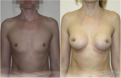 Маммопластика. Бага Д.К.