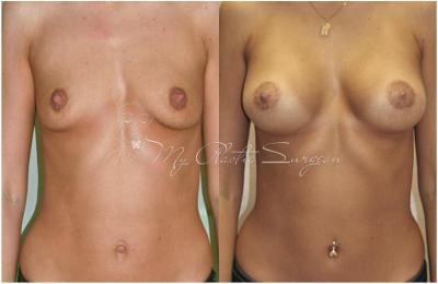 Маммопластика. Древецкий А.П.