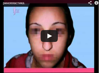 Ринопластика. Гришкян Д.В.